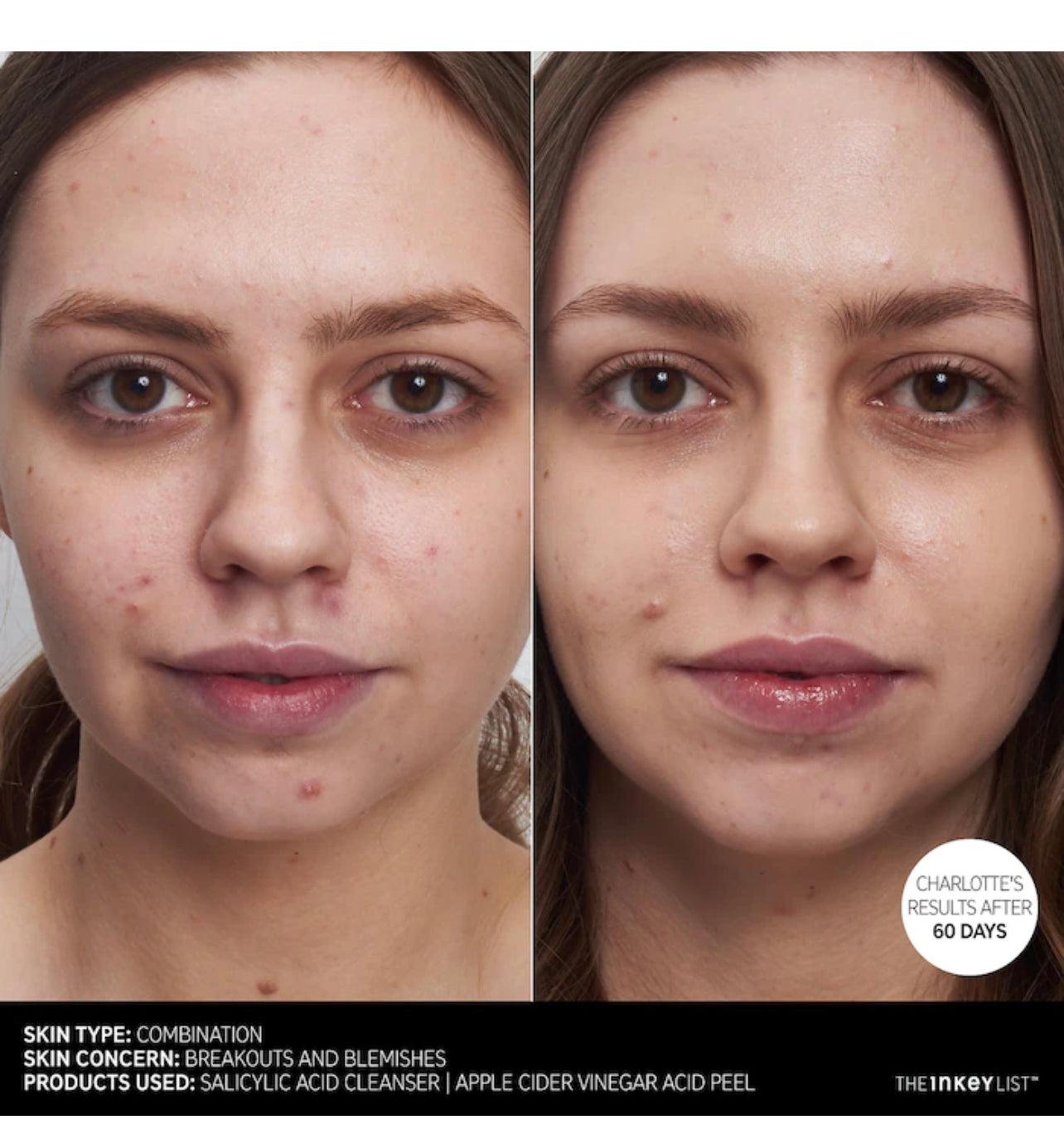 THE INKEY LIST SALICYLIC ACID ACNE+PORE CLEANSER
