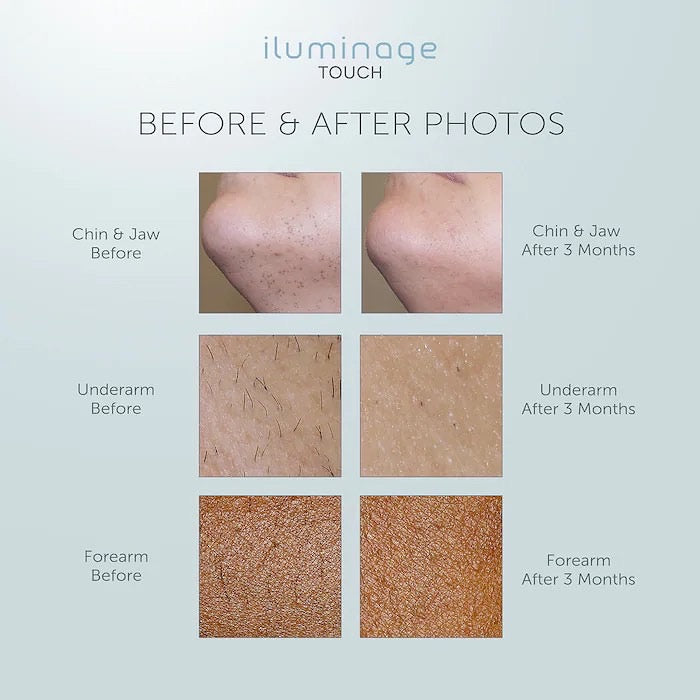 ILUMINAGE, TOUCH HOME PERMANENT HAIR REMOVAL DEVICE