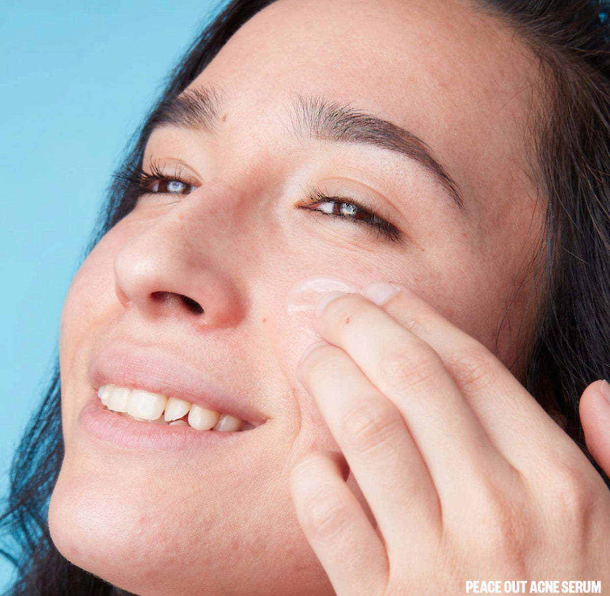 PEACE OUT, ACNE CHAMPS