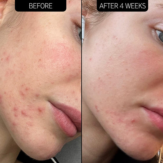 The INKEY List, SuperSolutions Acne Clearing Moisturizer 2% NOVORETIN