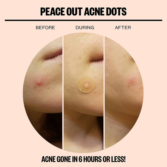 Peace Out Salicylic Acid Acne Healing Dots Mega Pack