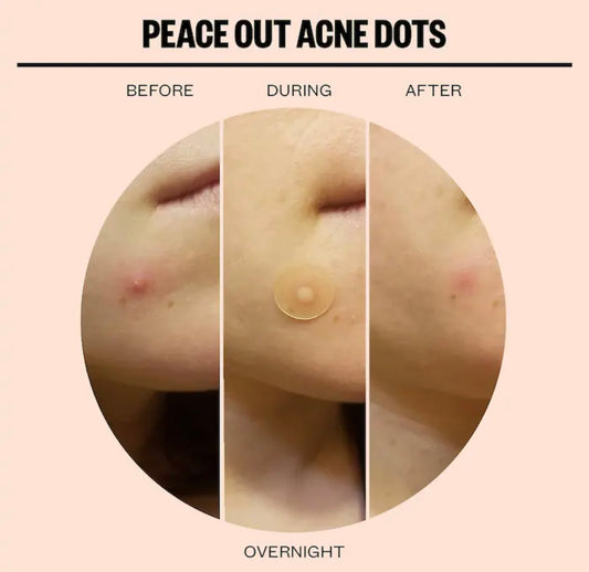 PEACE OUT, ACNE CHAMPS