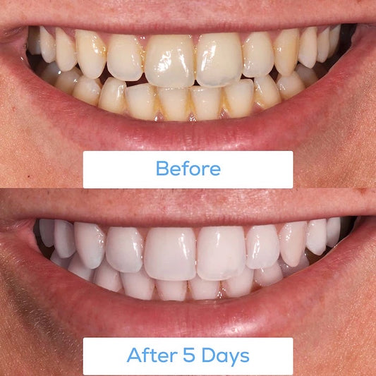 GLO SCIENCE, GLO BRILLIANT WHITE SMILE AT HOME TEETH WHITENING DEVICE